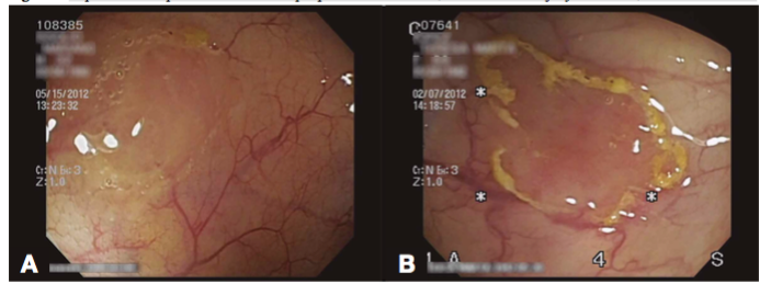 Aspectos endoscópicos de los adenomas/pólipos serrados sésiles. A) Borde con burbujas y detritus. B) Borde con detritus. 