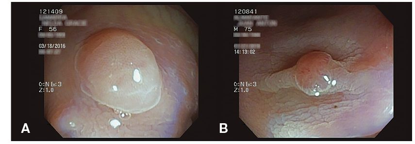 Cromoendoscopía con ácido acético en pólipos hiperplásicos (A) y adenoma tubular (B).