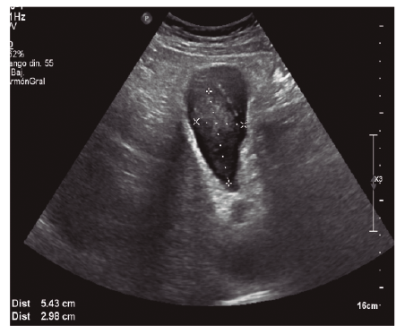 Imagen ecogr&aacute;fica d&oacute;nde visualizamos ves&iacute;cula biliar con contenido hemorr&aacute;gico en su interior con dimensiones de 5,4 x 2,9 cm.