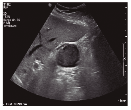 Imagen ecogr&aacute;fica de corte transversal de ves&iacute;cula biliar con engrosamiento de la pared (6,9 mm).
