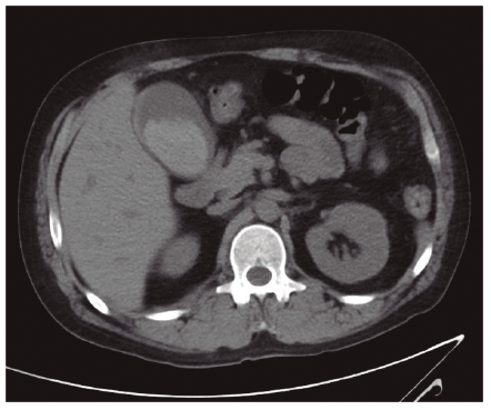 Corte axial de TAC con ves&iacute;cula de paredes engrosadas y contenido hemorr&aacute;gico