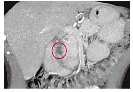 TCMD con contraste oral y endovenoso: imagen oval, hipodensa, compatible con quiste de la pared duodenal (c&iacute;rculo).