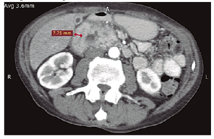 TCMD con contraste EV, corte axial, se marca el engrosamiento parietal del duodeno.