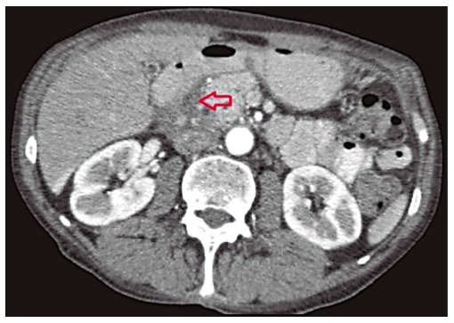 TCMD corte axial: se se&ntilde;ala con flecha roja una zona con rarefacci&oacute;n de la grasa.