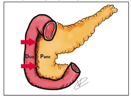 En este dibujo esquem&aacute;tico se se&ntilde;ala con flechas rojas el surco entre el duodeno (Duo) y el p&aacute;ncreas (Panc) donde se produce la patolog&iacute;a descripta.