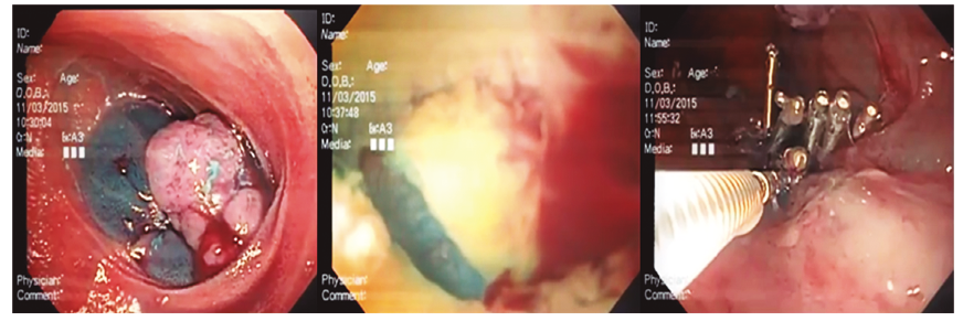 Polipectomía perforación y cierre en paciente con Peutz Jhegers.