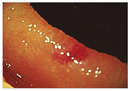 Angiodisplasia yeyunal.