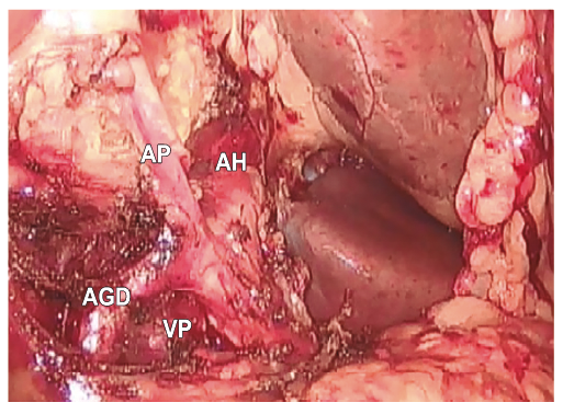 Disección de la arteria hepática, arteria gastroduodenal, arteria pilórica y vena porta luego de la resección del ganglio de la estación ganglionar número ocho. AH: arteria hepática; AGD: arteria gastroduodenal; AP: arteria pilórica; VP: vena porta.