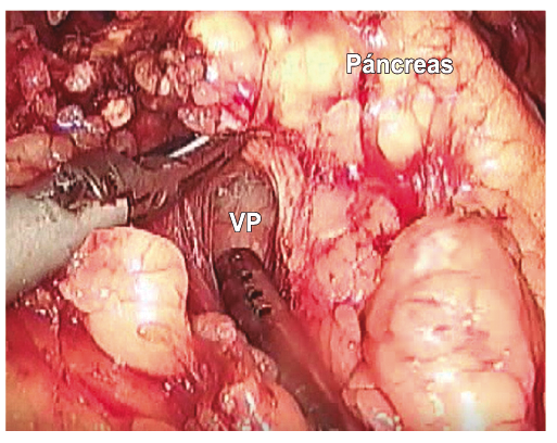 Labrado del túnel retropancreático VP vena porta