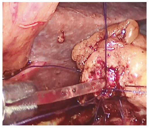 Anastomosis pancreatoyeyunal ducto mucosa tutoriza da con catéter de silicona