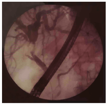 ERCP without obvious common bile duct stone but with a stricture in the common hepatic duct.