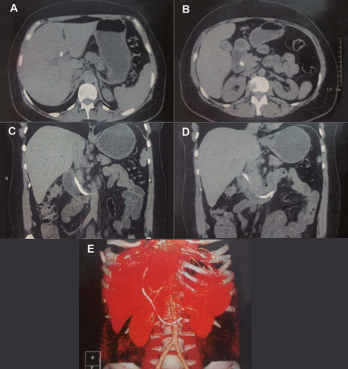 A) Computed tomography showing the prosthesis in the intrahepatic biliary tract. B) Computed tomography showing the prosthesis exteriorization via the duodenal papilla. C-E) Computed tomography of a coronal section showing the prosthesis placed in the biliary tract during ERCP