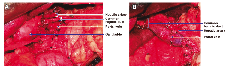 A) Intraoperative view showing hepatic artery, common hepatic duct, portal vein and gallbladder. B) Intraoperative view showing hepatic artery, common hepatic duct and portal vein.