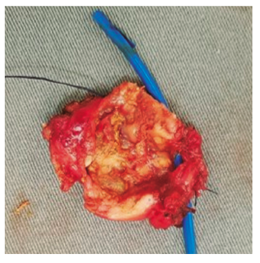 Gallbladder open to the biliary duct.