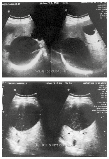 Ecografía abdominal. Hígado de aspecto heterogéneo, dado por la presencia de varios quistes. El de mayor tamaño mide 10 x 8,5 cm, de paredes regulares con detritus en su interior, tiene un volumen aproximado de 421 cc.  En el segmento VII observamos dos quistes simples de 2,5 x 2,8 cm y 2,1 x 1,5 cm.