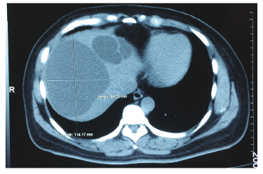 TAC de abdomen. Hígado de tamaño normal, contornos regulares, con imágenes hipodensas de contornos bien definidos con densidad de agua (8 UH), dispersas en el lóbulo derecho e izquierdo; la de mayor tamaño mide 114 x 94 x 105 mm en el segmento hepático VIII, y otras de menor tamaño que miden entre 10 y 20 mm en el segmento II y VII.