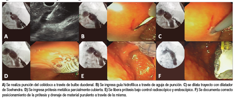 Secuencia de drenaje biliar ecoguiado mediante t&eacute;cnica de coledocoduodenostom&iacute;a