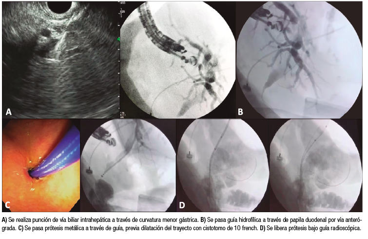 Secuencia de drenaje biliar ecoguiado transpapilar anter&oacute;grado