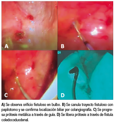Secuencia de resoluci&oacute;n endosc&oacute;pica de complicaci&oacute;n tard&iacute;a (migraci&oacute;n)
