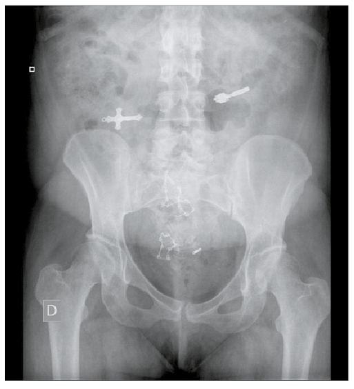 Radiograf&iacute;a simple de abdomen en paciente tras ingesta reiterada de m&uacute;ltiples CE: cremalleras pendientes y crucifijo.