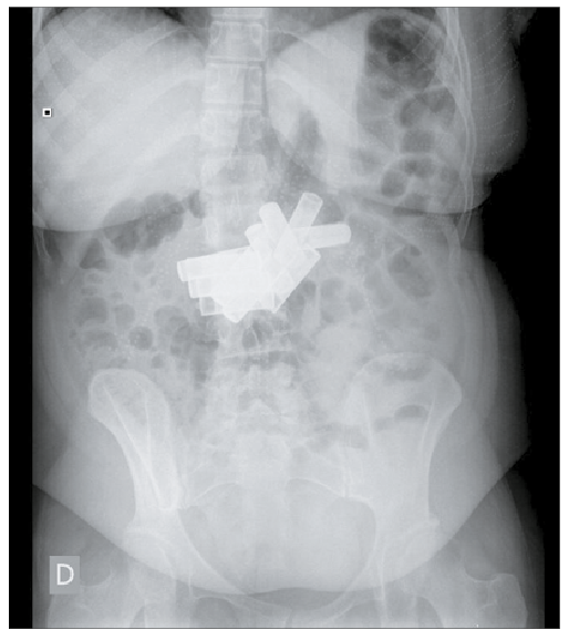 Radiograf&iacute;a simple de abdomen de la misma paciente de la fotograf&iacute;a anterior, pero de otro episodio de ingesta de doce pilas cil&iacute;ndricas tama&ntilde;o AA