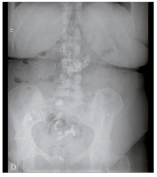 Radiograf&iacute;a simple de abdomen en paciente del tercer caso descrito tras ingesta reiterada de m&uacute;ltiples CE punzantes (clavos y chinchetas) con fines autol&iacute;ticos