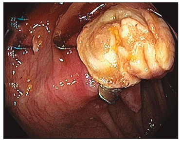 Paciente 2: visi&oacute;n intraluminal de los bordes del peritoneo sujetos con el clip