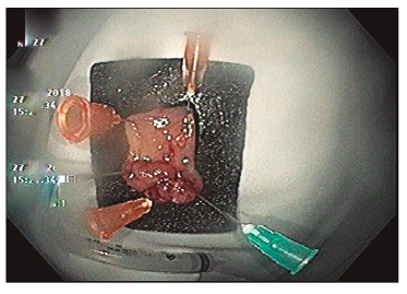 Paciente 2: pieza resecada