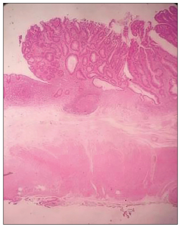 Paciente 2: adenoma tubulovelloso con displasia de alto grado (categor&iacute;a Viena 3 y 4.1). Tinci&oacute;n: hematoxilina eosina