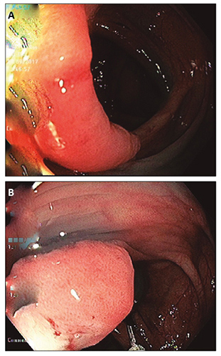 A y B Paciente 3 lesi&oacute;n plana elevada de 35 mm en &aacute;ngulo hep&aacute;tico