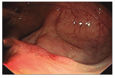 Paciente 3: lesi&oacute;n elevada residual, indurada a la semiolog&iacute;a endosc&oacute;pica