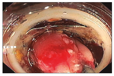 Paciente 3: lesi&oacute;n enfrentada con la FTRD