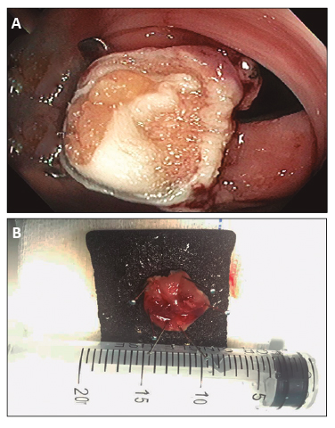 A) Paciente 3: visi&oacute;n intraluminal de los bordes del peritoneo sujetos con el clip. B) Pieza resecada 