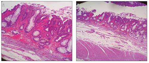 A y B) Paciente 3: adenoma tubular con una displasia de alto grado categor&iacute;a Viena 41 Tinci&oacute;n hematoxilina eosina
