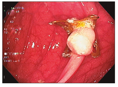 Paciente 1: se observa el clip Ovesco