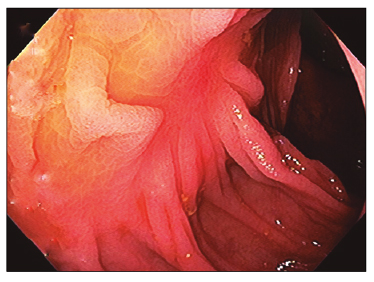 Paciente 2: &aacute;rea de resecci&oacute;n cicatrizal