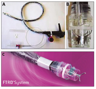 A y B Dispositivo Full Thickness Resection Device FTRD Ovesco Endoscopy Tübingen Germany gentileza de Ovesco C Imagen de Full Thickness Re section Device gentileza de Ovesco