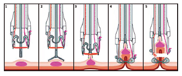Proceso de resecci&oacute;n gentileza de Ovesco