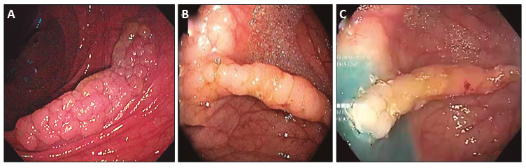 A y B)Paciente 1: lesi&oacute;n con extensi&oacute;n lateral de tipo granular. C)Paciente 1: lesi&oacute;n con "lifting sign" negativo