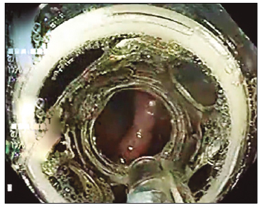 Paciente 1: lesi&oacute;n enfrentada con el sistema FTRD