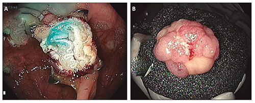 A) Paciente 1: visi&oacute;n endoluminal del clip y del peritoneo B) Pieza resecada