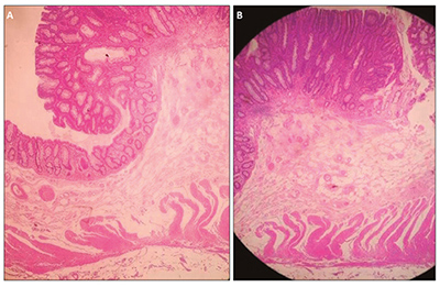  A y B) Paciente 1: adenoma tubulovelloso con displasia de alto grado (categor&iacute;a Viena 4.1). Tinci&oacute;n con hematoxilina eosina