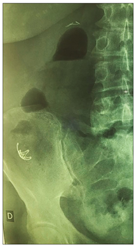 Paciente 1: clip en ciego con indemnidad perito neal a 5 h de la resecci&oacute;n