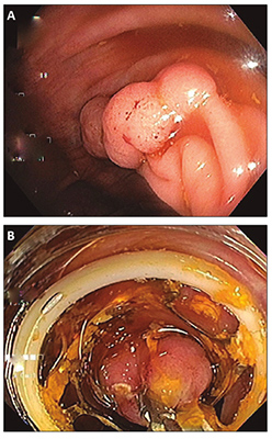 A) Paciente 2: lesi&oacute;n adenomatosa con extensi&oacute;n lateral. B) Paciente 2: lesi&oacute;n enfrentada con FTRD