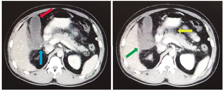 Tomograf&iacute;a computada con reconstrucci&oacute;n axial de abdomen con contraste oral y endovenoso