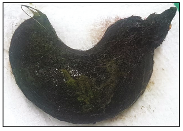 Tricobezoar encontrado en la paciente