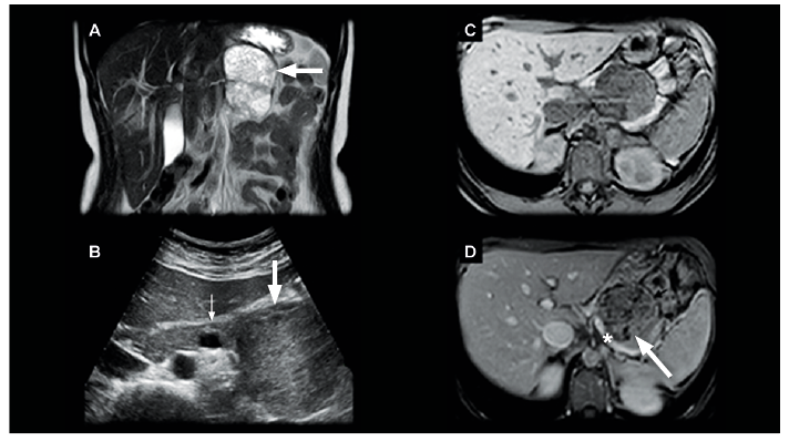 RM abdomen. A) T2 Haste coronal. B) Ecotomograf&iacute;a de abdomen en regi&oacute;n de epigastrio centrado en el p&aacute;ncreas. C) T1 Fatsat sin contraste axial. D) T1 Fatsat con contraste fase portovenosa axial