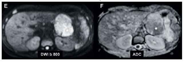 Im&aacute;genes complementarias de estudio RM, que demuestran extensos focos de restricci&oacute;n en difusi&oacute;n (E) con correlato en el mapa ADC (F) de baja se&ntilde;al que representan alta celularidad (*)