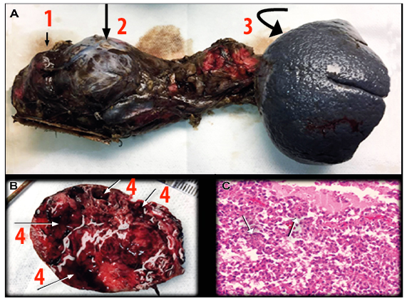 A) Fotograf&iacute;a de pieza quir&uacute;rgica: (1) p&aacute;ncreas normal; (2) masa en cuerpo-cola del p&aacute;ncreas; (3) bazo. B) Fotograf&iacute;a de macroscop&iacute;a tumoral: (4) focos de hemorragia intratumoral. C) Fotograf&iacute;a de microscop&iacute;a (HE 40x). Se observan grupos de c&eacute;lulas disgregadas sin centro conectivo, lo que da un aspecto pseudopapilar, sin atipias