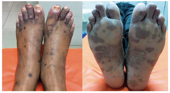 A) Lesiones violáceas tipo pápula en los pies. B) Algunas coalescentes formando placas en las plantas